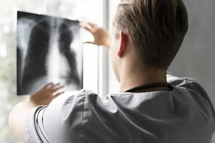 Туберкульоз в Канівській громаді: за тиждень діагностовано 4 випадки захворювання